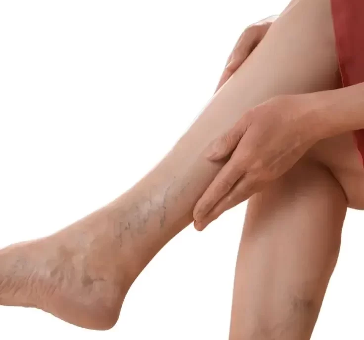 Vein Surgery